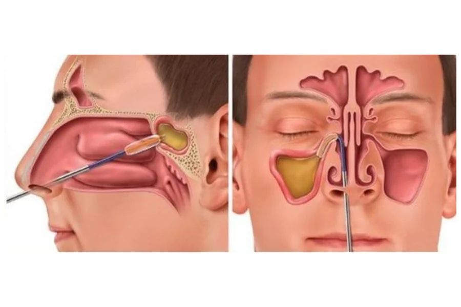 Sinus Surgery Singapore