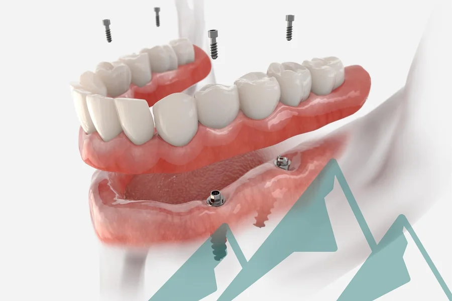 Traditional Dentures