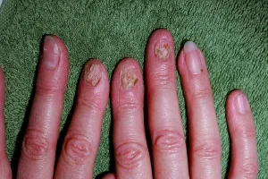 Early Signs of Psoriatic Arthritis Singapore When to See a Rheumatologist