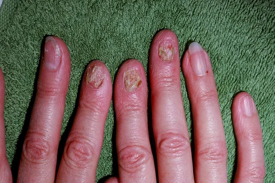 Early Signs of Psoriatic Arthritis Singapore When to See a Rheumatologist