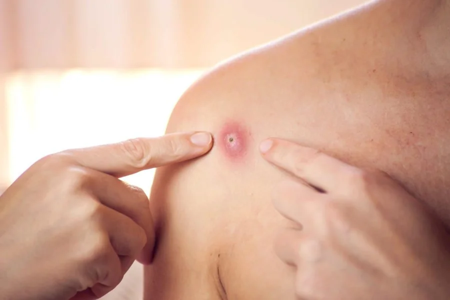 Skin Lumps Removal Singapore