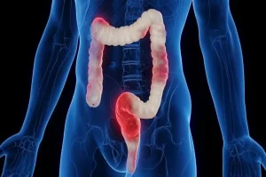 How A Colon Specialist Singapore Can Help With Unexplained Rectal Bleeding